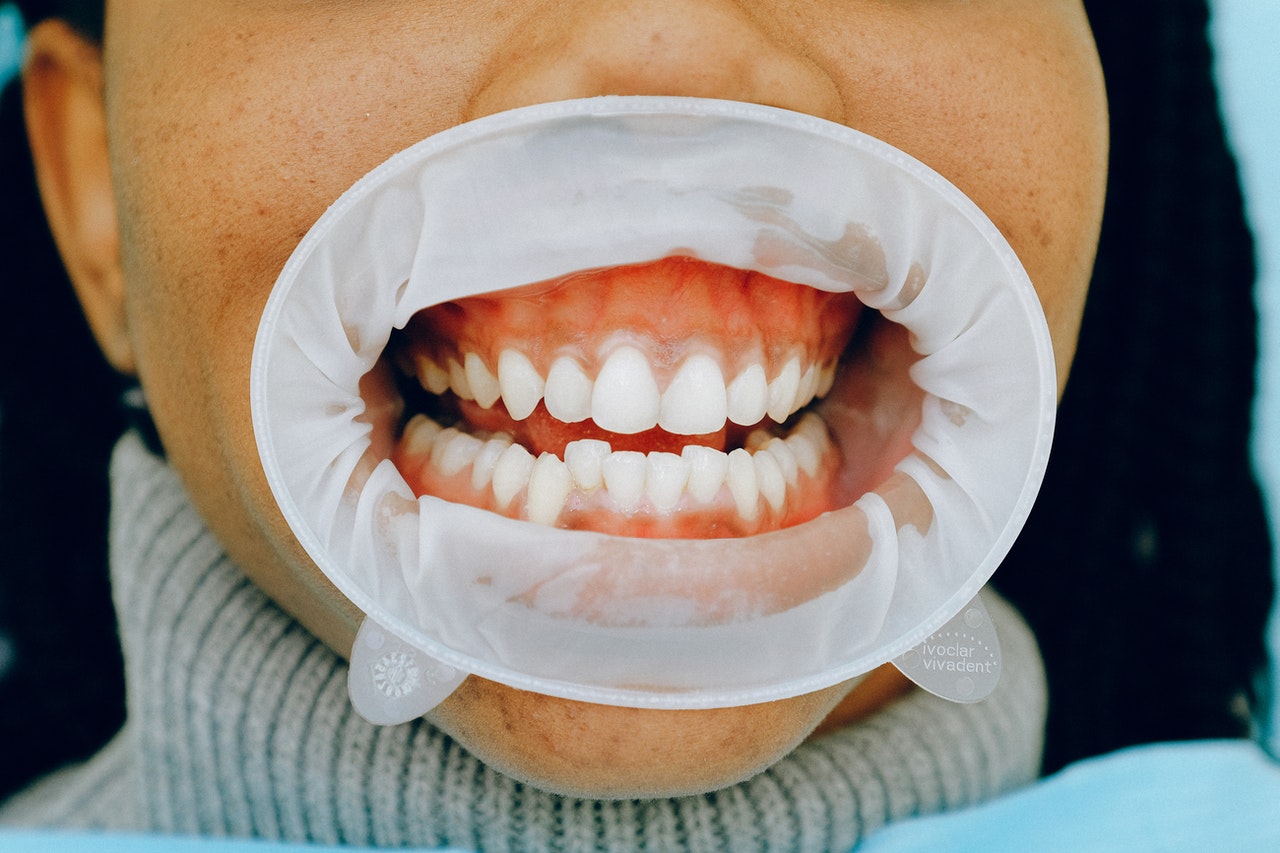 Sensitive Teeth: Causes, Symptoms, Prevention & Teeth Whitening Tips