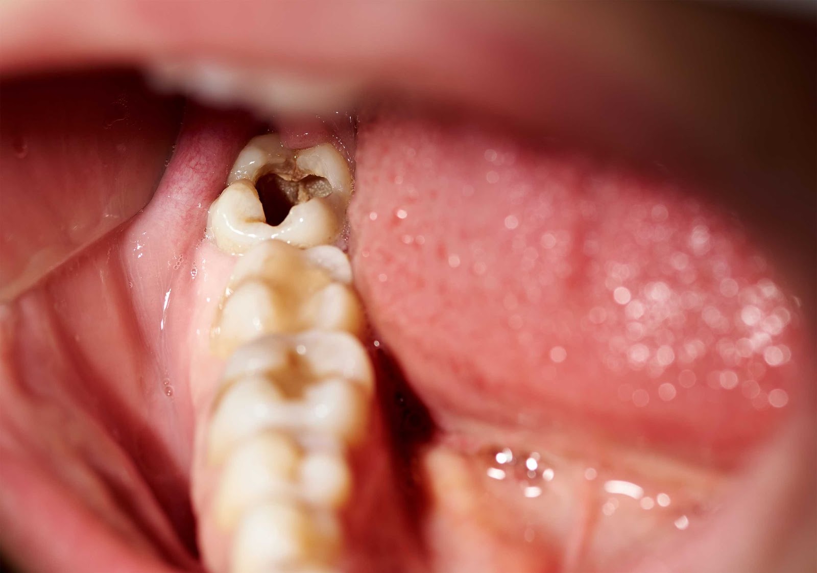 The Tooth Decay Process: How To Reverse It and Avoid a Cavity